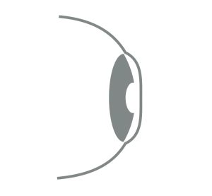 Orthokeratology Fig.4 Lens Removed