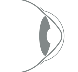2024-387 - Vision Camberwell - Illustration Scleral Contact Lens Outline of a scleral lens vaulting over the eye with keratoconus