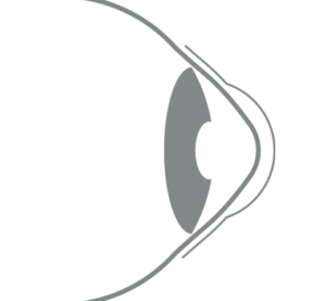 2025-188 - Vision Camberwell - Hybrid Lens Illustration Outline of a hybrid lens vaulting over the eye with keratoconus
